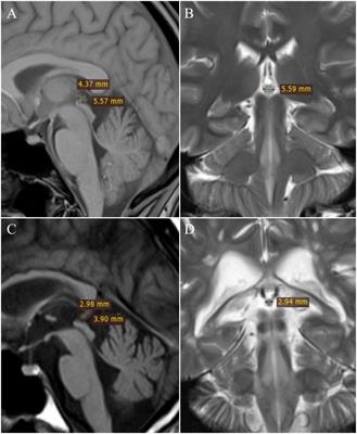 Pineal gland volume loss in females with multiple sclerosis